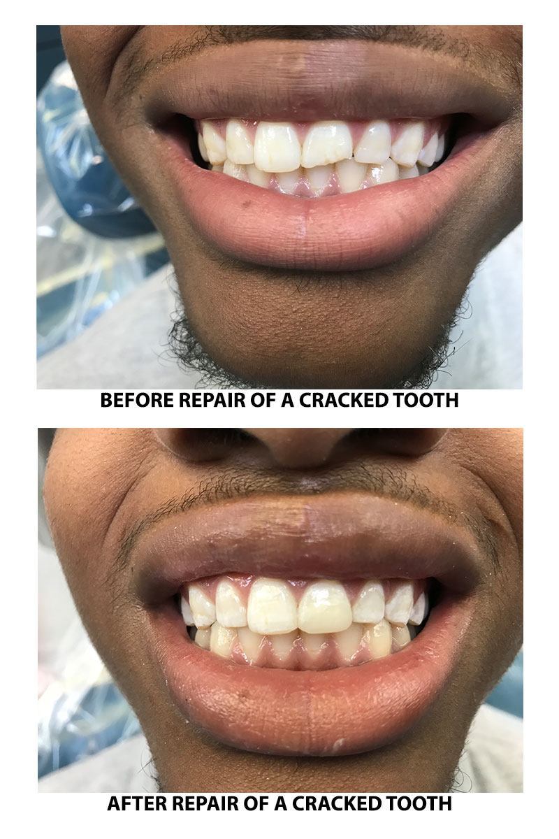 chipped tooth repair after - Wake Orthodontics & Pediatric Dentistry