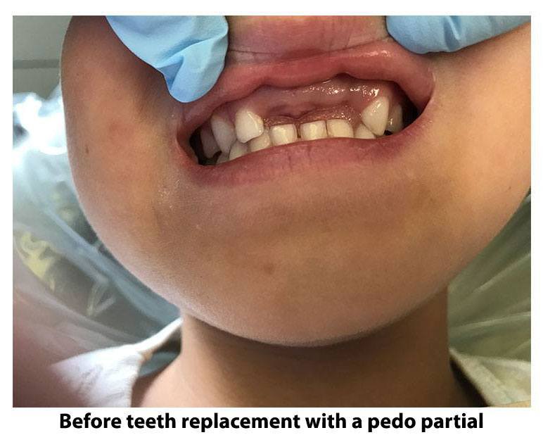 Teeth replacement with a pedo partial