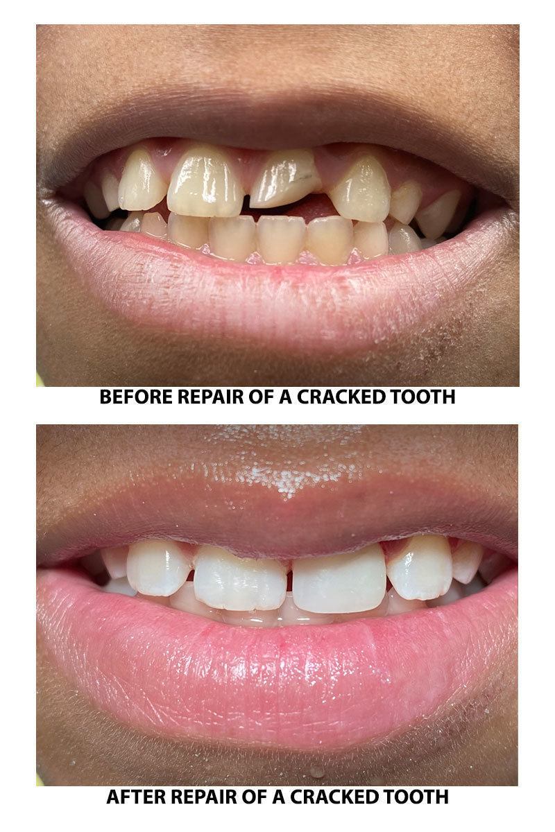 Repair of a cracked tooth on second patient